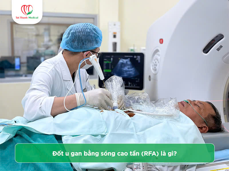 Địa chỉ mua máy đốt sóng cao tần u gan chính hãng, giá tốt