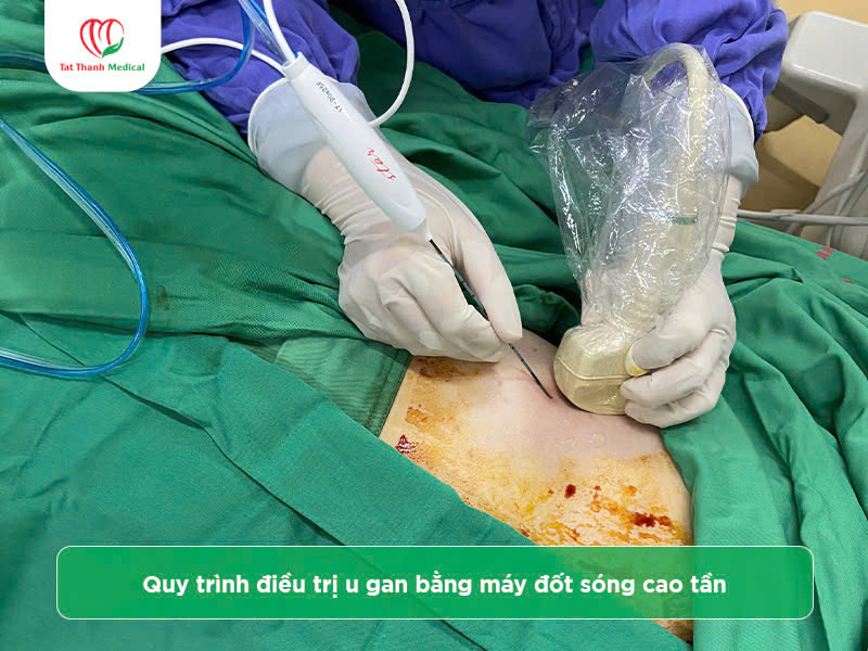 Địa chỉ mua máy đốt sóng cao tần u gan chính hãng, giá tốt