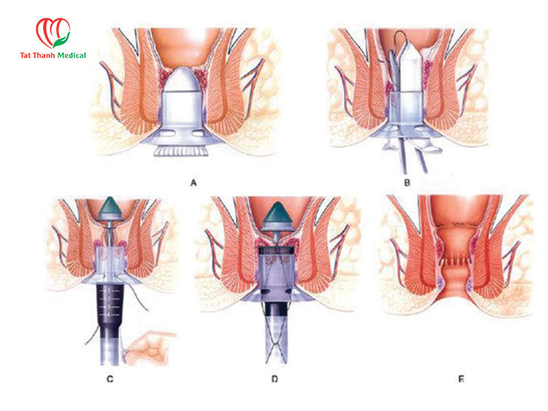RFA điều trị trĩ và phẫu thuật truyền thống: So sánh từ dữ liệu lâm sàng đến lựa chọn điều trị