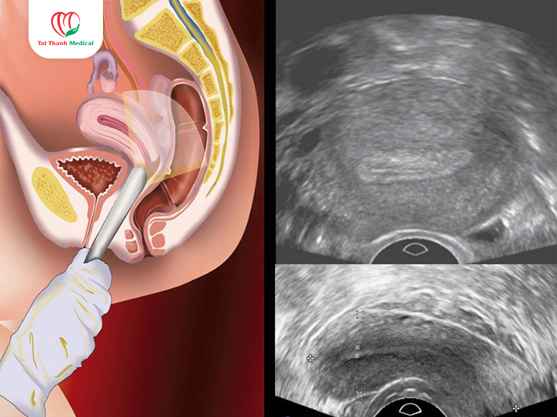 RFA u xơ tử cung: Xu hướng điều trị ít xâm lấn giúp bảo tồn tử cung cho phụ nữ trong độ tuổi sinh sản